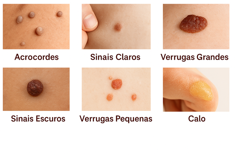 WipeOff - Trate as Verrugas, Manchas e Marcas com Ingredientes Naturais!