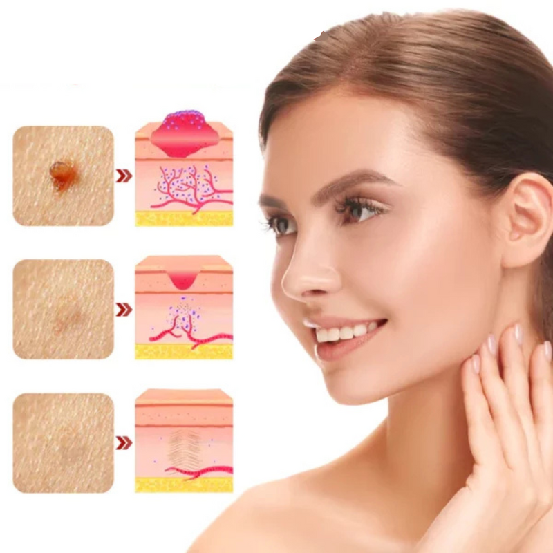 WipeOff - Trate as Verrugas, Manchas e Marcas com Ingredientes Naturais!