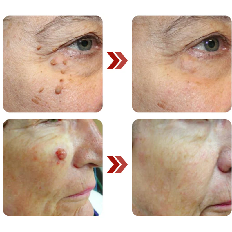 WipeOff - Trate as Verrugas, Manchas e Marcas com Ingredientes Naturais!